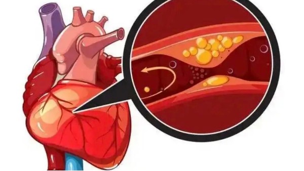 真實(shí)案例：是什么讓他堅(jiān)持一年，冠狀動(dòng)脈堵塞消除30%！