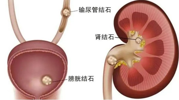 重用、活用水蛭治療尿路結(jié)石，療效較好