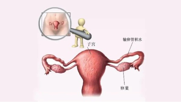 水蛭有利水道、破積聚之功，可用于治療輸卵管積水