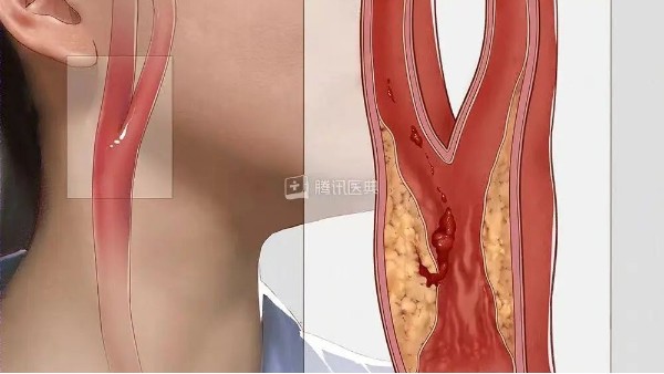 真實(shí)案例丨3個(gè)月左頸動(dòng)脈狹窄降低約27%，是怎么實(shí)現(xiàn)的？