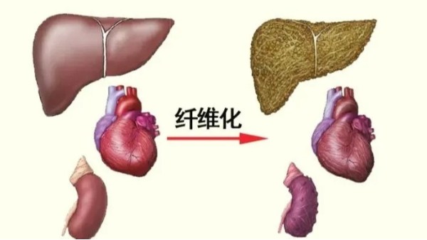 水蛭是臨床常用的活血藥物，能有效治療器官纖維化