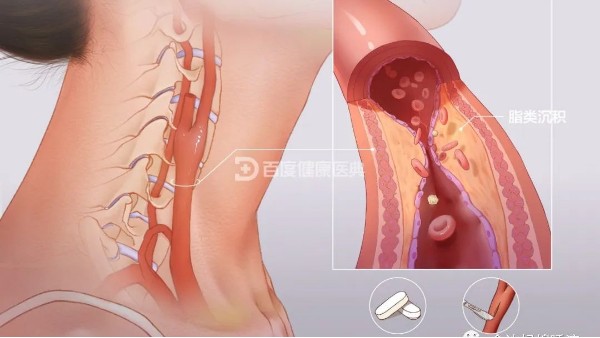真實案例 | 從有到無，一個月多雙頸動脈斑塊“消失術(shù)”