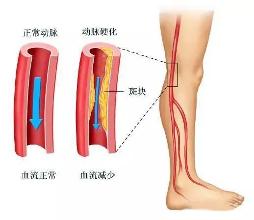 水蛭素、下肢動(dòng)脈硬化、下肢閉塞