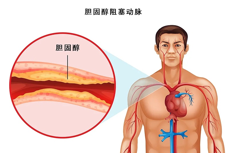 水蛭素、脖子粗、血管硬化