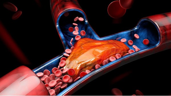 血栓最容易堵在身體3個(gè)地方！有這4個(gè)信號(hào)一定要留意→
