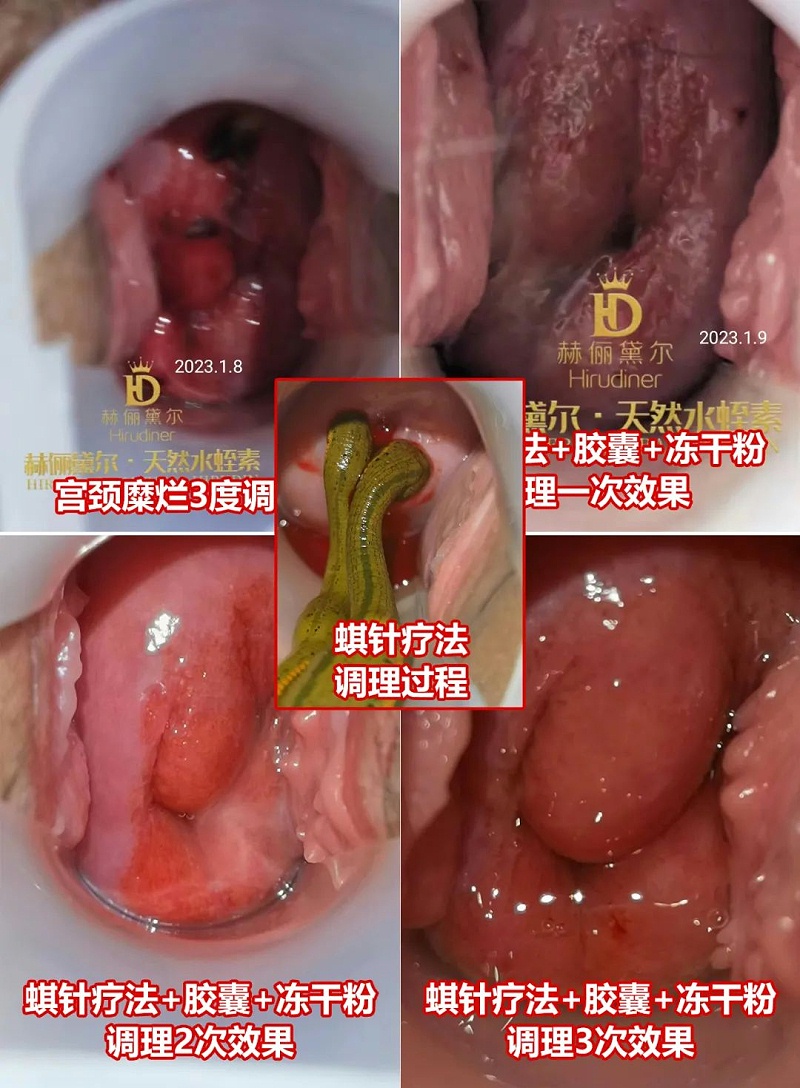 水蛭素、水蛭素膠囊、生殖婦科