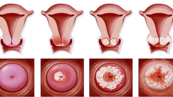 得了「宮頸糜爛」，怎么辦？