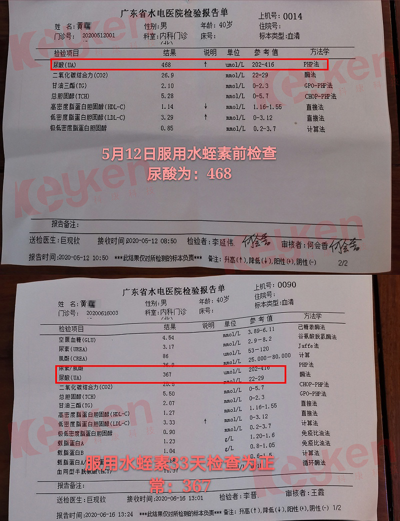 水蛭素、尿酸、痛風(fēng)