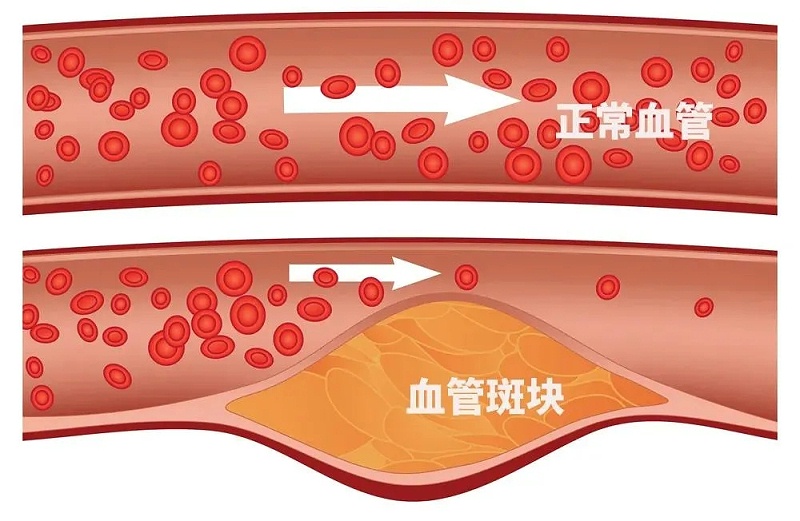 水蛭素、通血管、血管堵塞