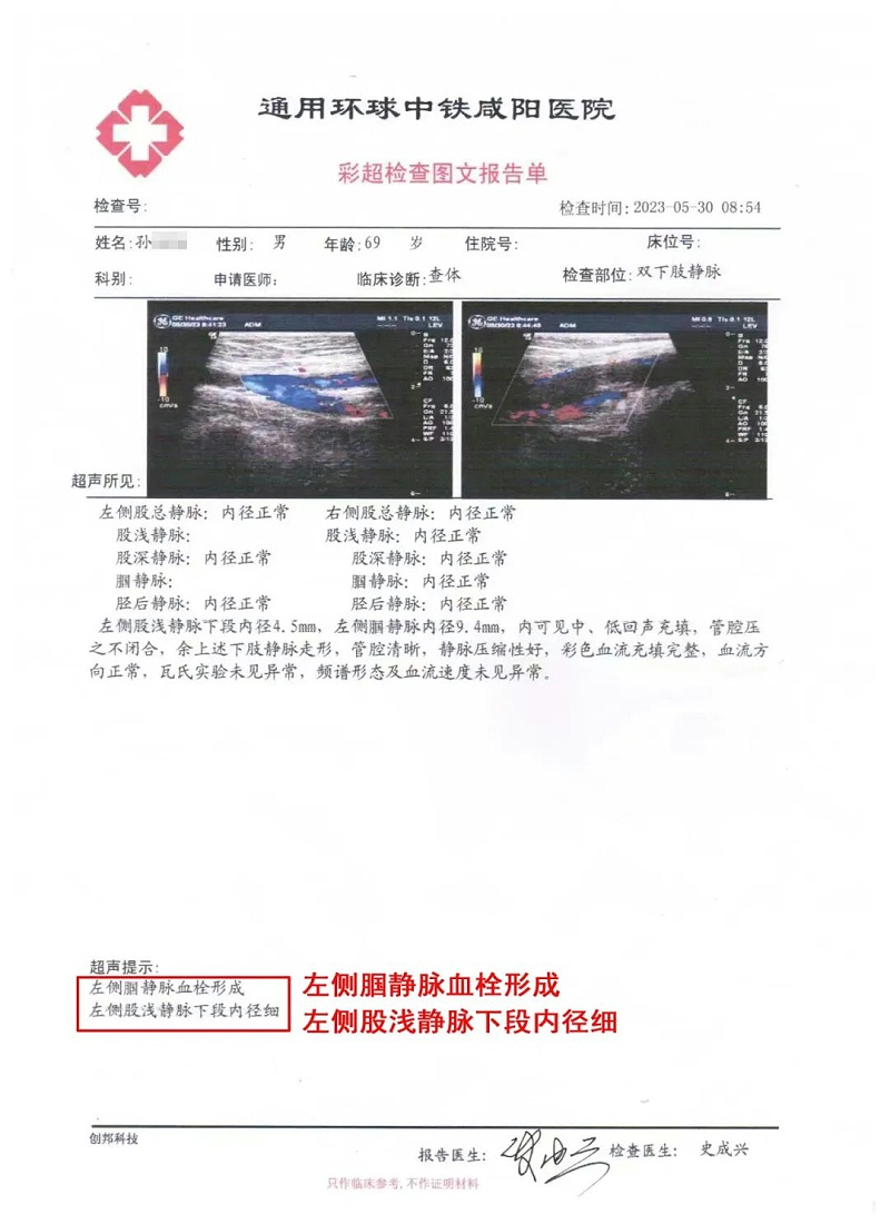 水蛭素、靜脈斑塊、血栓