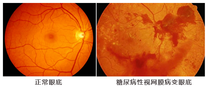 水蛭素、糖尿病、視網(wǎng)膜病變