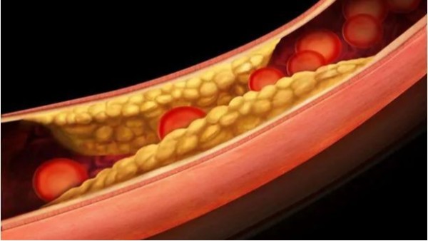 三高如何引起動脈粥樣硬化斑塊？——高血壓篇