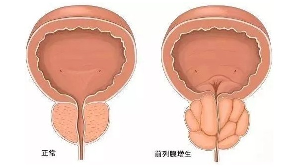 水蛭在改善前列腺增生臨床癥狀、提高生活質(zhì)量方面發(fā)揮重要作用