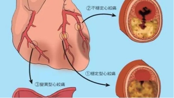 尿酸高不僅導(dǎo)致痛風(fēng)，還可能威脅你的心臟和大腦！