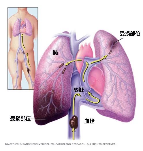 水蛭素、猝死、心梗