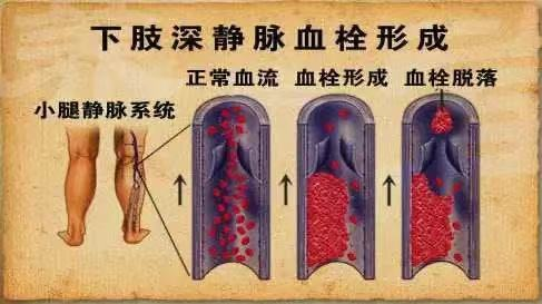 水蛭素、水蛭療法、下肢靜脈栓塞