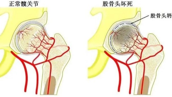 水蛭通脈湯治療股骨頭無(wú)菌性壞死效果顯著